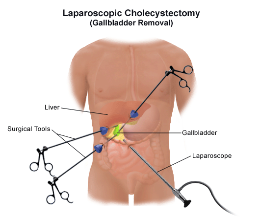 Cholecystectomy
