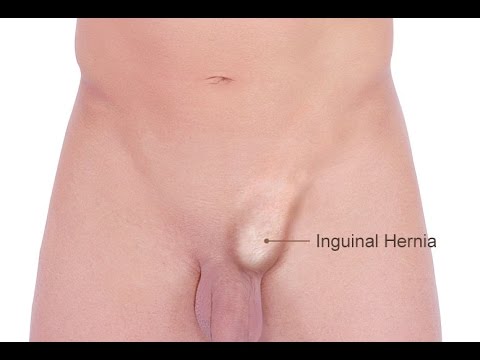 Inguinal Hernia Repair