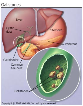 Gallbladder Surgery