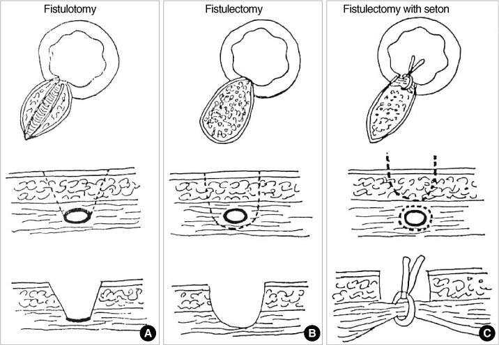 Fistulectomy