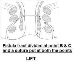 Ligation of intersphincteric Fistula tract