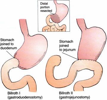Cancer Stomach